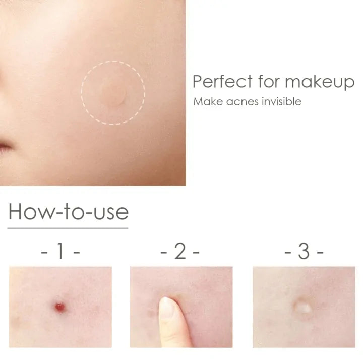 🌿 Roo Approved! Beauty Acne Patch Set – Bye Blemishes, Hello Confidence! ✅